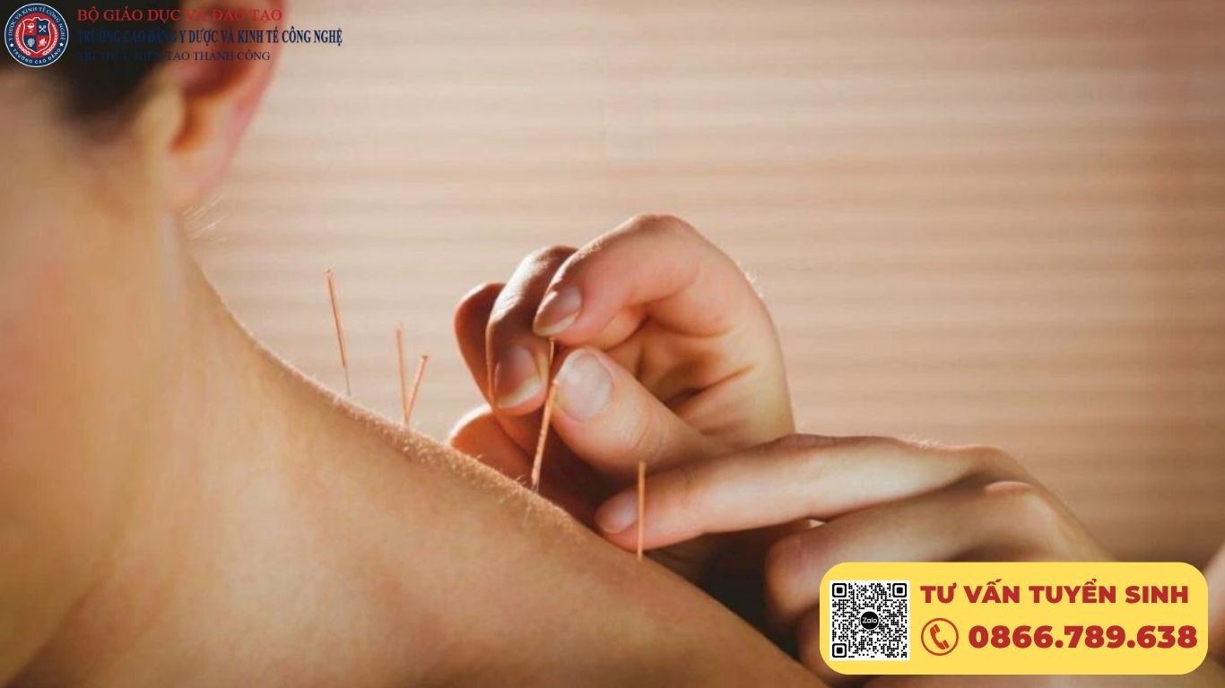 Khóa học Châm cứu tại CMET là lựa chọn hàng đầu cho những ai muốn theo đuổi nghề châm cứu bài bản, hợp pháp và có thu nhập ổn định